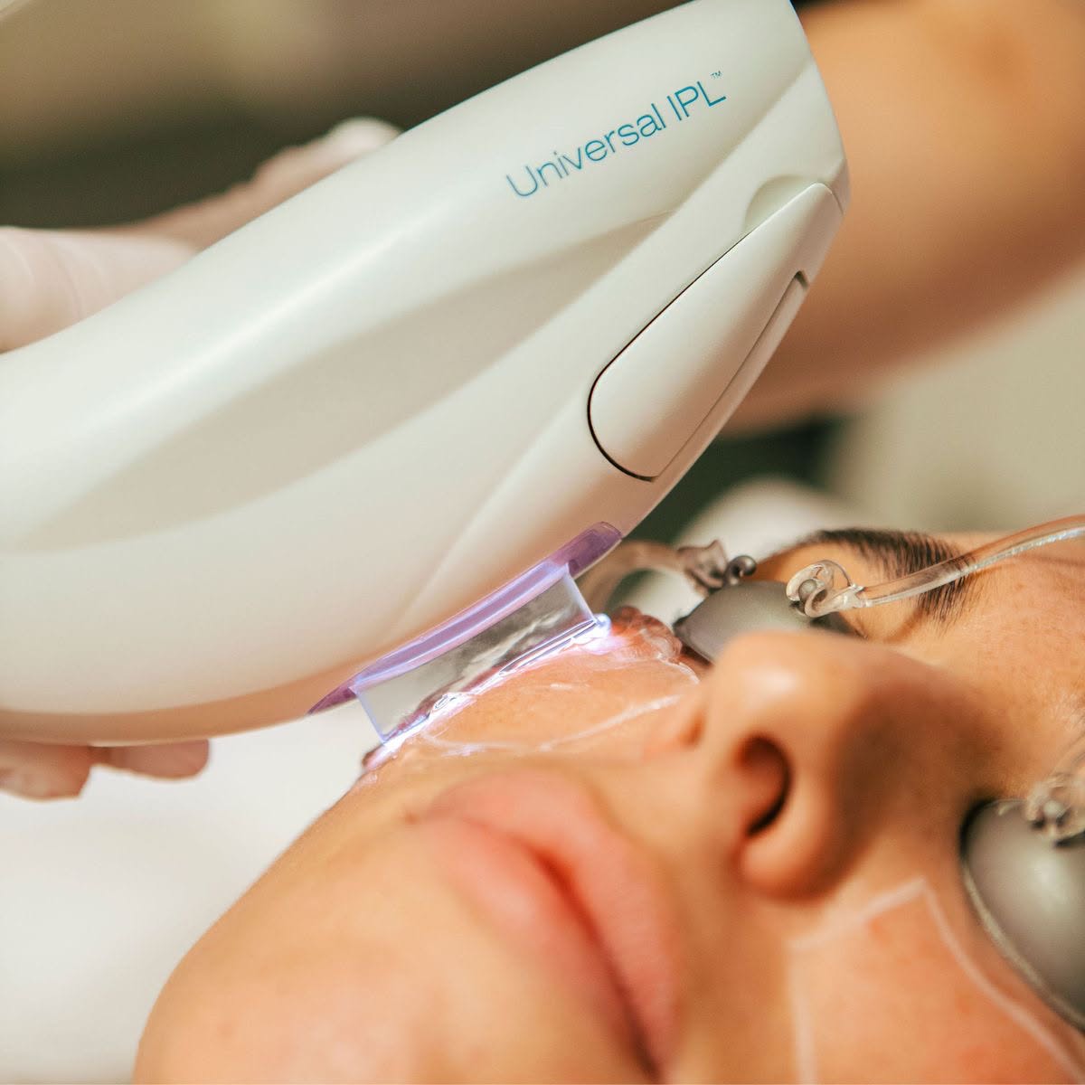 Chemical Peel